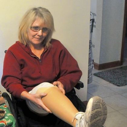 Catherine Fielding, a double amputee, puts on her prosthetic leg in her Richland home.